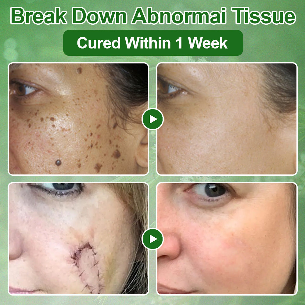 🔥Skavix™  Tea Tree Oil Skin Treatment Cream✅𝐅𝐃𝐀-𝐀𝐏𝐏𝐑𝐎𝐕𝐄𝐃 – Removes Skin Blemishes, Repairs Damaged Skin, Brightens & Anti-Ageing Care