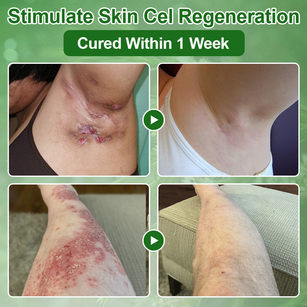 🔥Skavix™  Tea Tree Oil Skin Treatment Cream✅𝐅𝐃𝐀-𝐀𝐏𝐏𝐑𝐎𝐕𝐄𝐃 – Removes Skin Blemishes, Repairs Damaged Skin, Brightens & Anti-Ageing Care